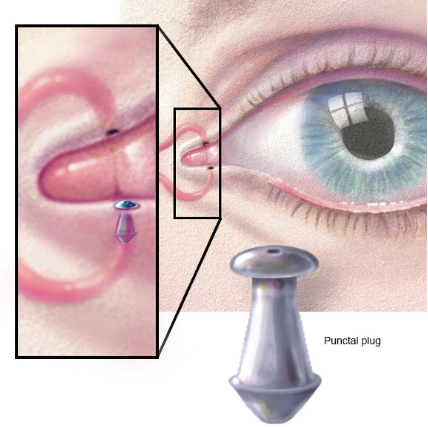 Punctal Plugs